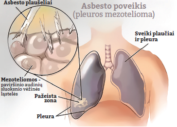 Asbestas - vėžinių susirgimų priežastis